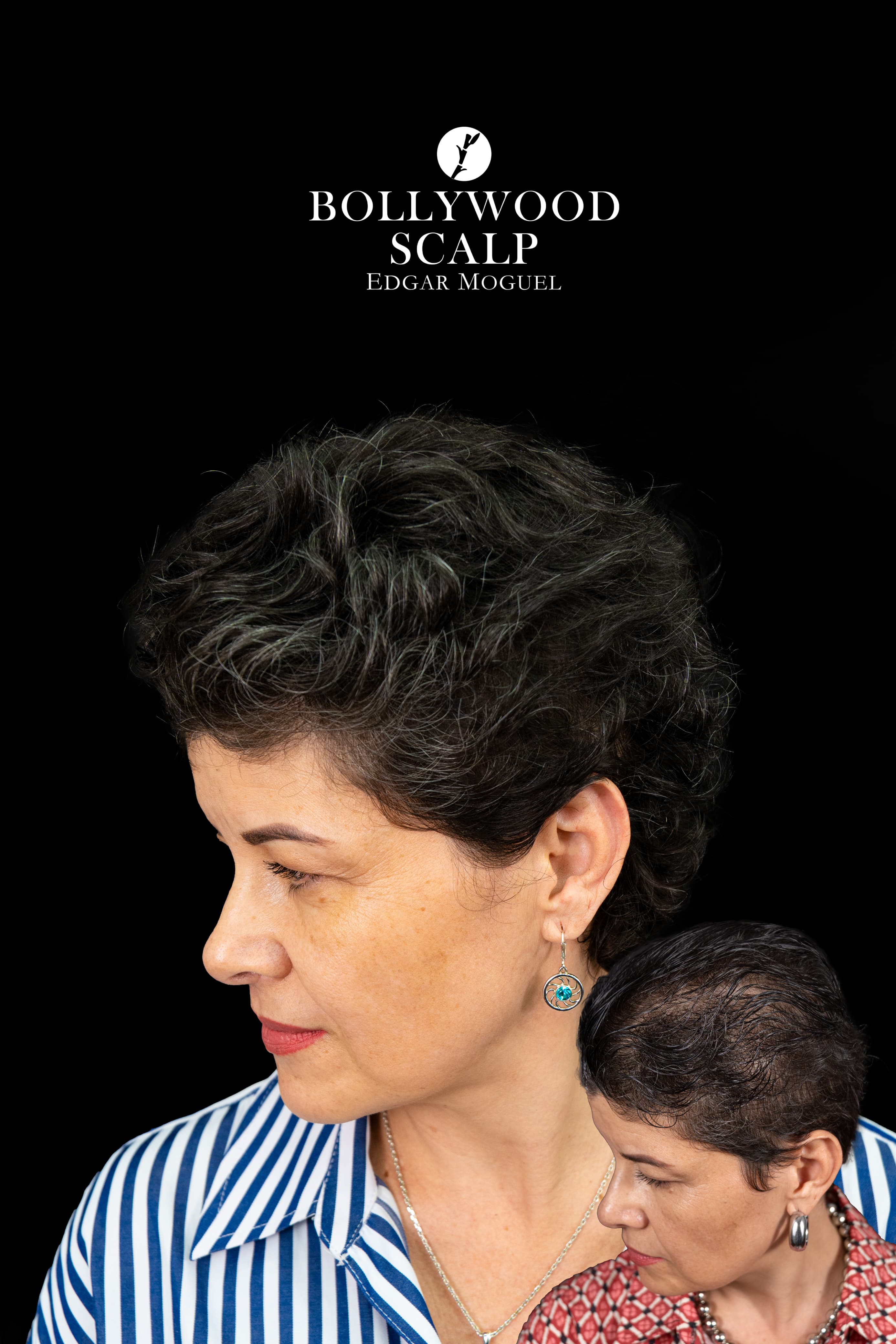 Resultado Capilar Femenino - Perfil Lateral