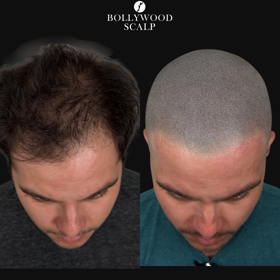 Micropigmentación Capilar - Antes y Después