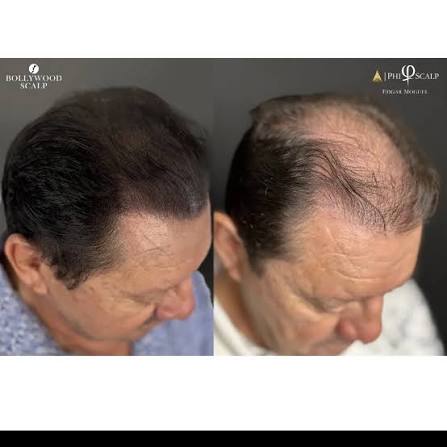 Antes y Después - Lateral