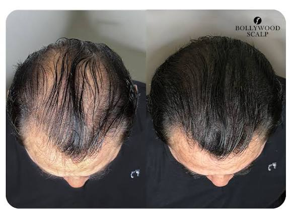 Resultado Capilar - Corona