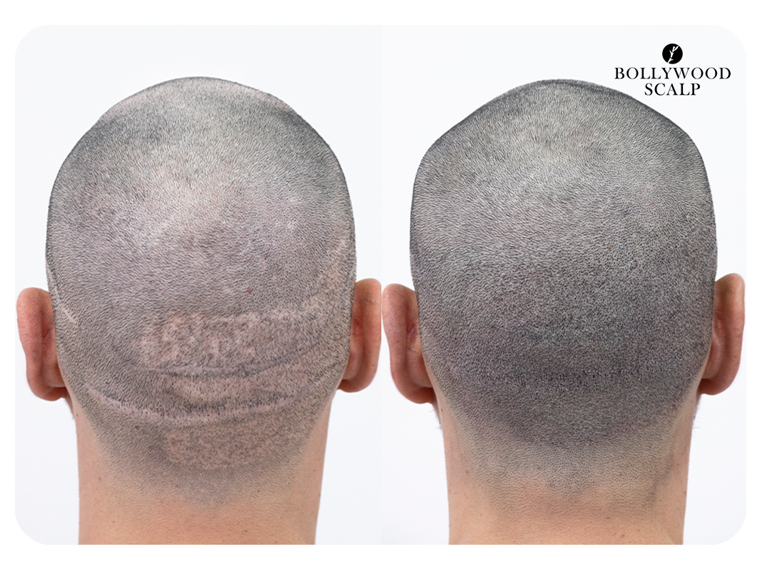 Resultado Capilar - Vista posterior